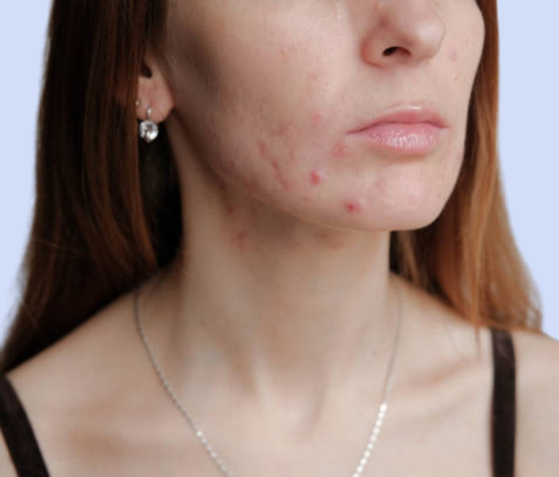 hormonal-acne-causes